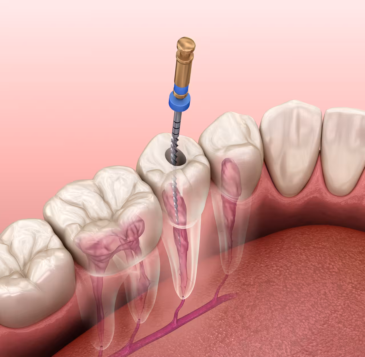 Is it Better to Get a Root Canal or Pull the Tooth?