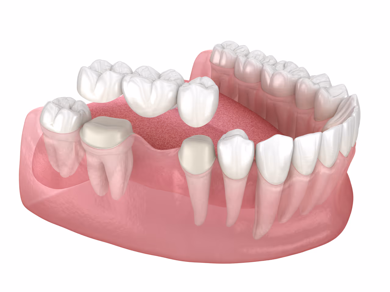 Caring for Your Dental Bridge: Tips for Getting Long-Lasting Results